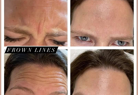 Anti Wrinkle Injections