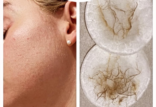 Dermaplane facials