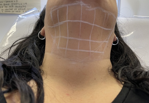 Double chin dissolve