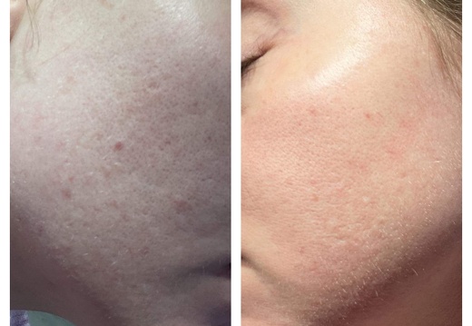 Microneedling Facials