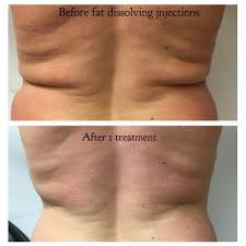 Fat Dissolving Injections 